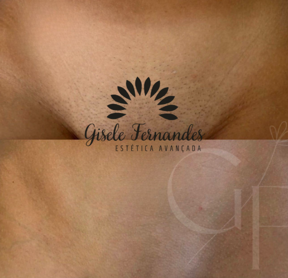 Depilação a Laser